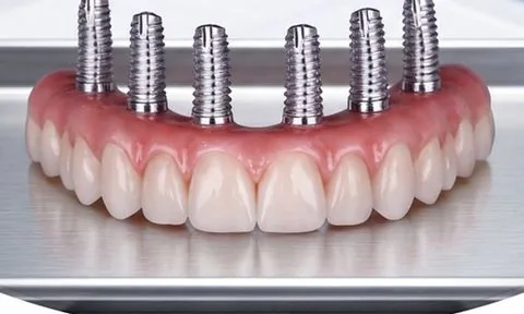 Full arch with implants
